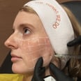 I Tried Skinvive, the Buzzy New "No-Filler" Filler