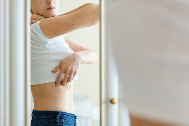 Woman looks in to a mirror an itching rash on dry flaky skin, as in the psoriasis, eczema and other diseases